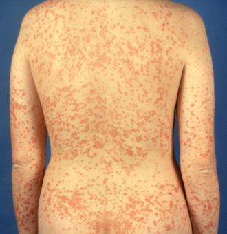 Generalisierte Psoriasis guttata (vor Therapie)