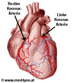 Herz von vorne: Herzkranzgefe (Arterien=Schlagadern rot eingezeichnet)