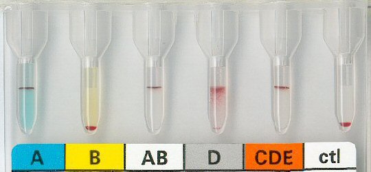 Blutgruppe A mit fraglichem Rhesus 