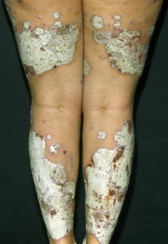 Chronische Plaquepsoriasis