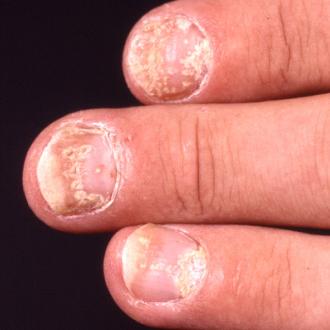 Psoriatische Fingernagelvernderungen