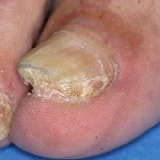 Psoriasis des Grozehennagels