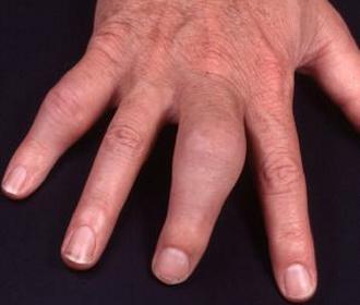 Psoriatische Arthritis