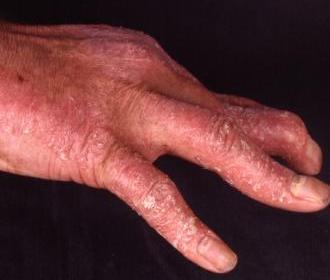 Psoriatische Arthropathie