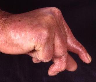 Psoriatische Arthropathie