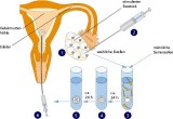 Ablauf einer IVF (in vitro Fertilisation)