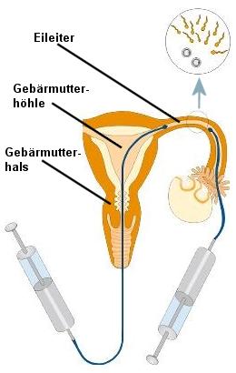 Schema des Gameten-Intrafallopian Transfers