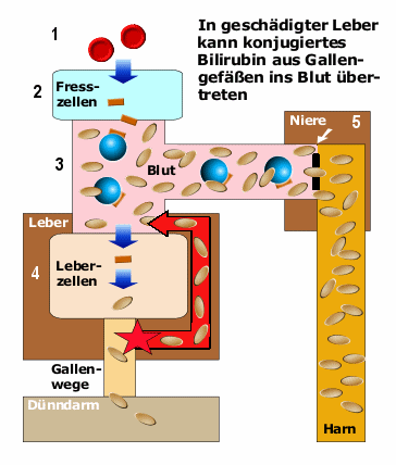 Schema des hepatischen Ikterus mit Erhhung des konjugierten, direkten Bilirubins (2)