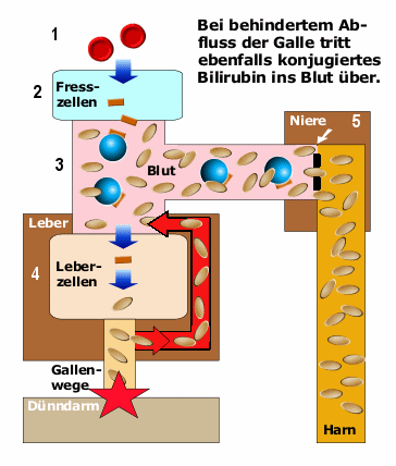 Schema des posthepatischen Ikterus mit Erhhung des konjugierten, direkten Bilirubins