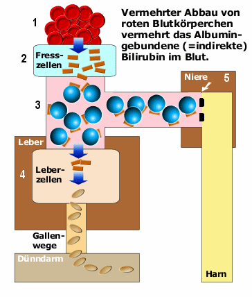 Schema des prhepatischen Ikterus mit Erhhung des unkonjugierten, indirekten Bilirubins