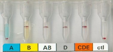 Blutgruppe B bestimmt mit Gelzentrifugationsmethode