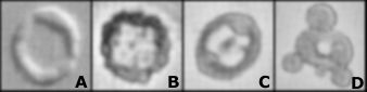 Verschiedene Formen dysmorpher Erythrozyten im Harn