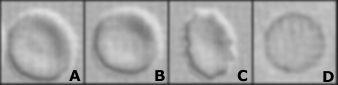 Verschiedene Formen nicht dysmorpher ("normaler") Erythrozyten im Harn