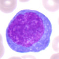 Atypischer Lymphozyt, vermutlich reaktiv (Immunoblast)