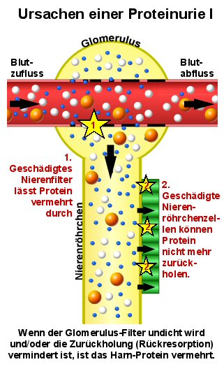 Schematische Darstellung der glomerulren und tubulren Proteinurie