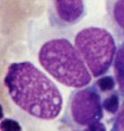 Bösartige Zellen eines Tumors der Schleimhaut der Harnwege
