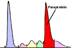 Beispiel eine Paraproteins in der Elektrophoresekurve