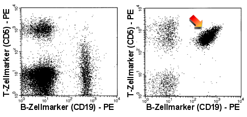 Die malignen B-Zellen (rechter Dot-Plot) zeigen eine starke CD5-Expression