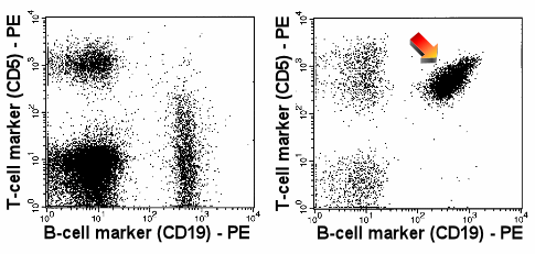 The malignant B-cells (right-hand dot-plot) show a strong expression of CD5