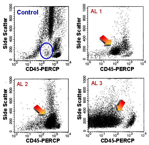 The CD45/Side Scatter plots help to detect CD34-negative blast populations.
