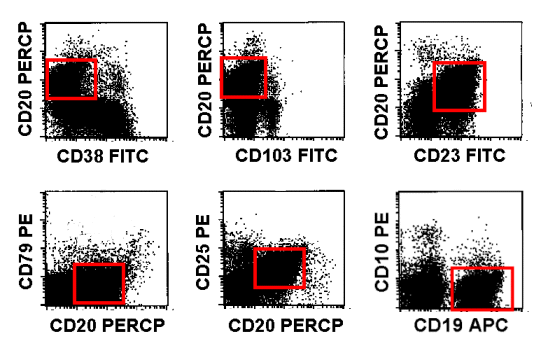 Immunophenotype of the malignant B-cells (the malignant cells are those with weak CD20 expression)