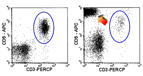 Loss of CD3 and overexpression of CD5 characterize the malignant T-cell population (arrow)