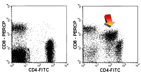 The simultaneous expression of CD4 and CD8 can help detecting malignant T-cells