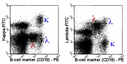 By their weak expression of CD19, the malignant B-cells become conspicuous