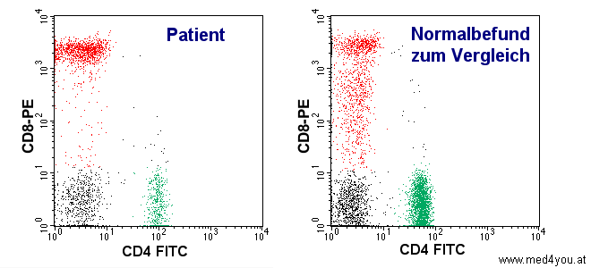 Helperzellen (grn) sind bei dem Patienten mit HIV-Infektion deutlich vermindert