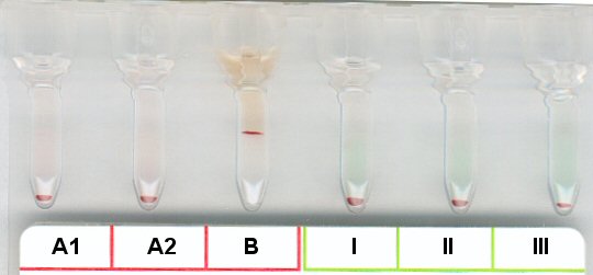 Serumgegenprobe bei Blutgruppe A