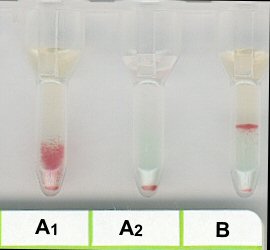 Serumgegenprobe in Liss/Coombs-Karte bei Immun Anti A1