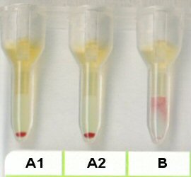 Serumgegenprobe in Liss/Coombs-Karte bei Immun Anti B