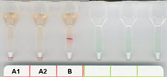 Serumgegenprobe fr Blutgruppe A