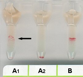 Serumgegenprobe bei 37 C in Liss/Coombs-Karte bei irregulrem Anti A1-IgG