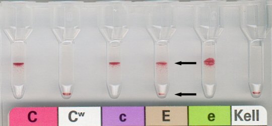 Rhesusuntergruppe CcEe mit Mischfeld in E